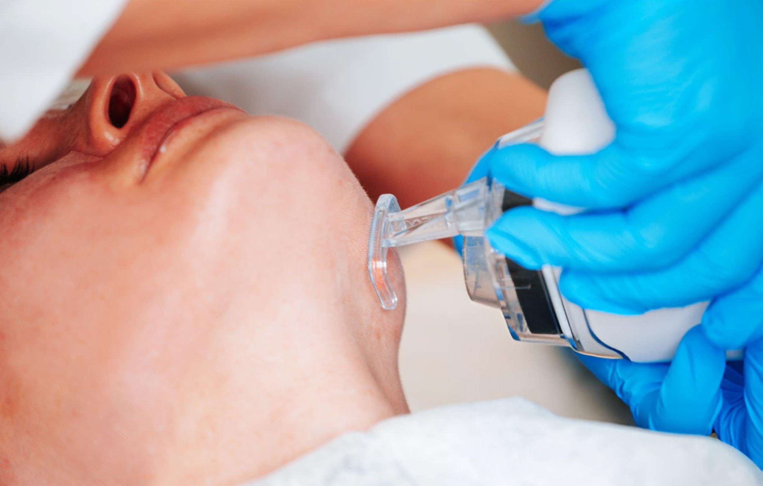 Ablative CO2 resurfacing results